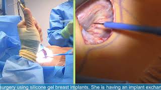 Breast Implant Exchange Surgery- Michael J. Brown, Md Live Stream