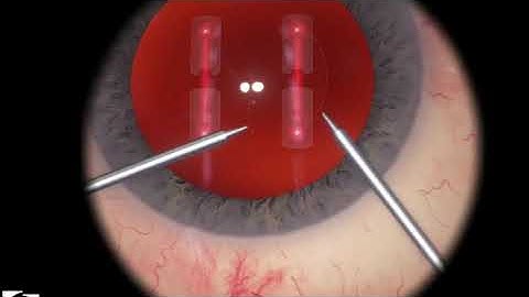 EyeSi CAT C Cracking and Chopping Training, Level 5