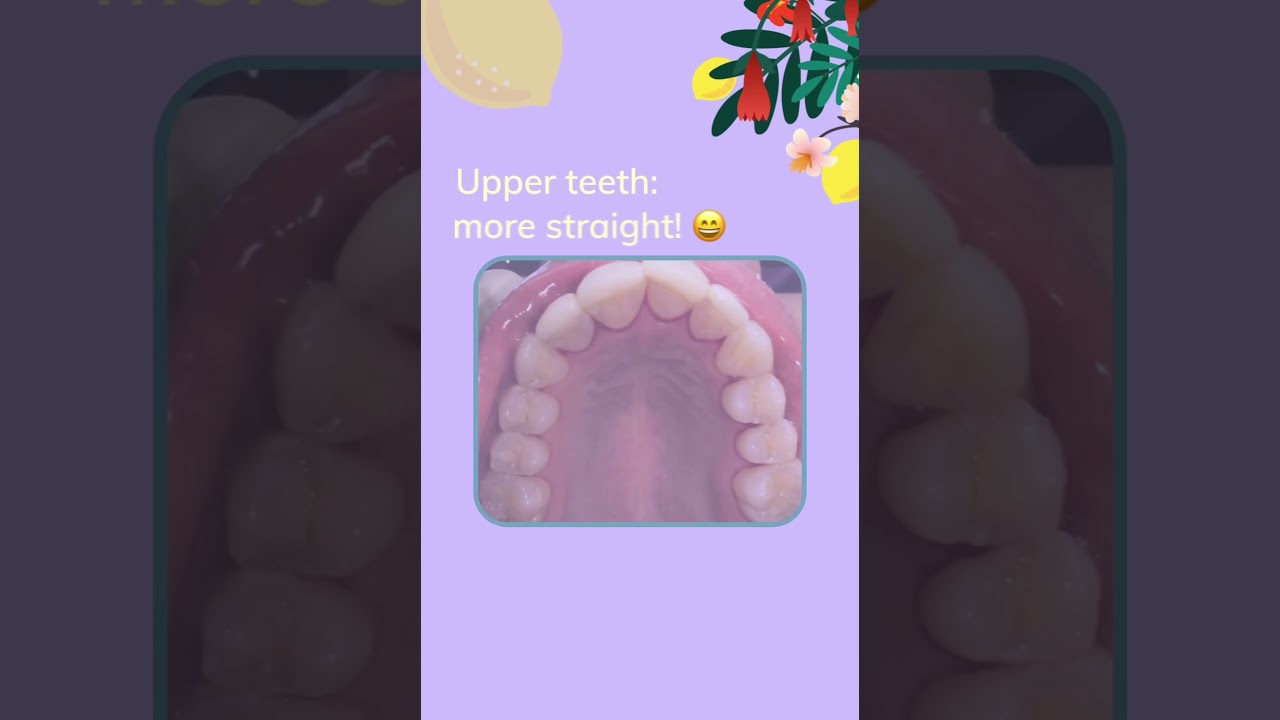 Invisalign before and after! AMAZING TRANSFORMATION