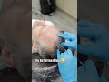Hair Botox and mesotherapy experience