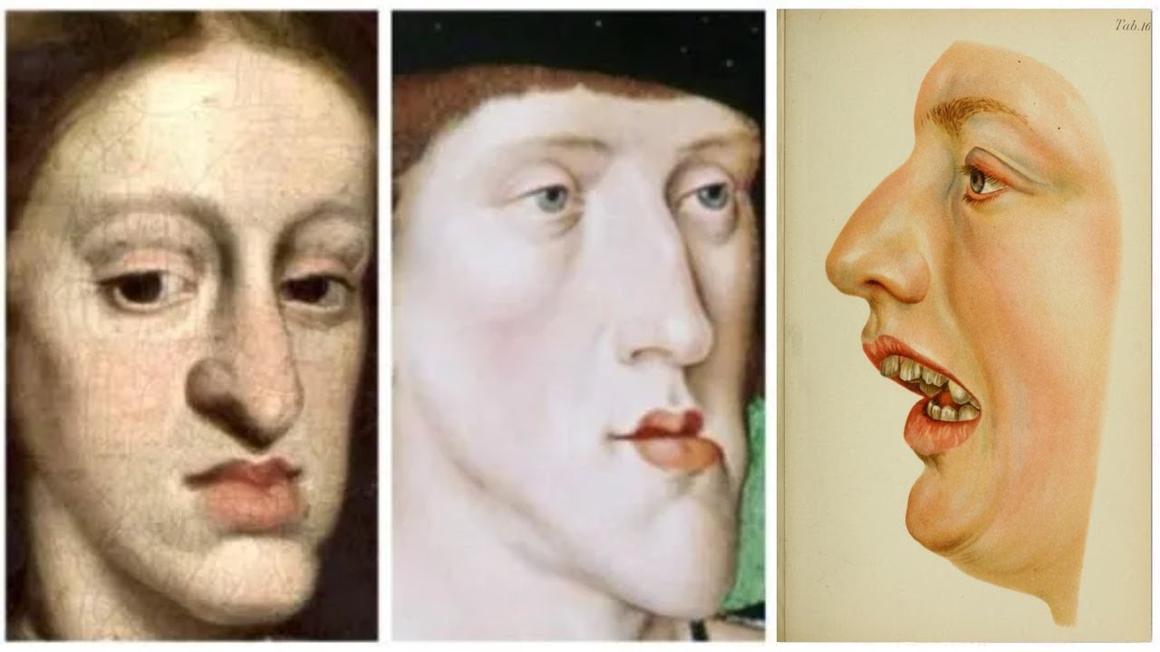 How Inbreeding Created Madness in Medieval Europe