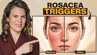 Rosacea Diet Triggers: The Foods Making Your Skin Red & Flushed | Dr. Mills, MD