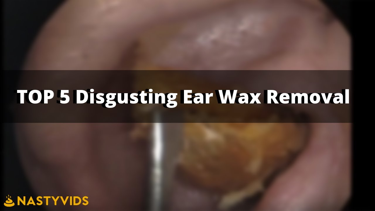 OMG!!! TOP 5 NASTY EAR WAX REMOVAL 2018 YouTube