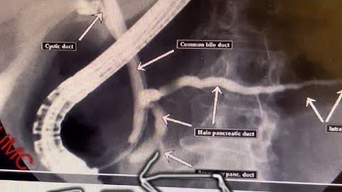 Endoscopic Retrograde Cholangiogram-Pancreatography (ERCP)