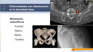 Sistema Musculoesquelético: Densidad ósea y tumores