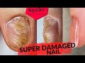 DAMAGED NAIL From Another Nail Tech 😱 TWO Corrections In ONE Video