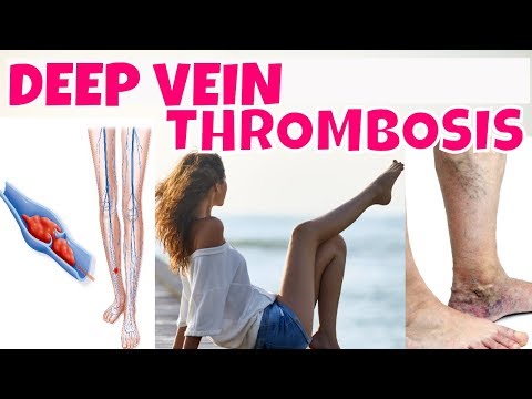 Video: Deep Vein Thrombosis (DVT) Risicofactoren En Tips Voor Preventie