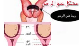 ندردش معكم شويا مشكل في عنق الرحم  نتمنى خير انشالله يارب