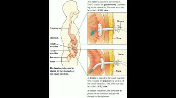 G tube J tube #doctor #shortsfeed #short