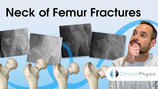 Neck of Femur Fractures | Expert Physio Review