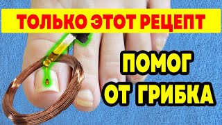 САМЫЙ РАБОЧИЙ РЕЦЕПТ от Грибка НОГТЕЙ, который Помог. Грибок ногтей на ногах лечение, как вылечить