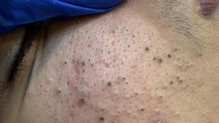 Get rid of blackheads and pimples with deep cleansing techniques