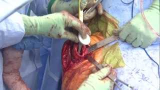 Reverse Total Shoulder Arthroplasty - Dr. Richard Hawkins