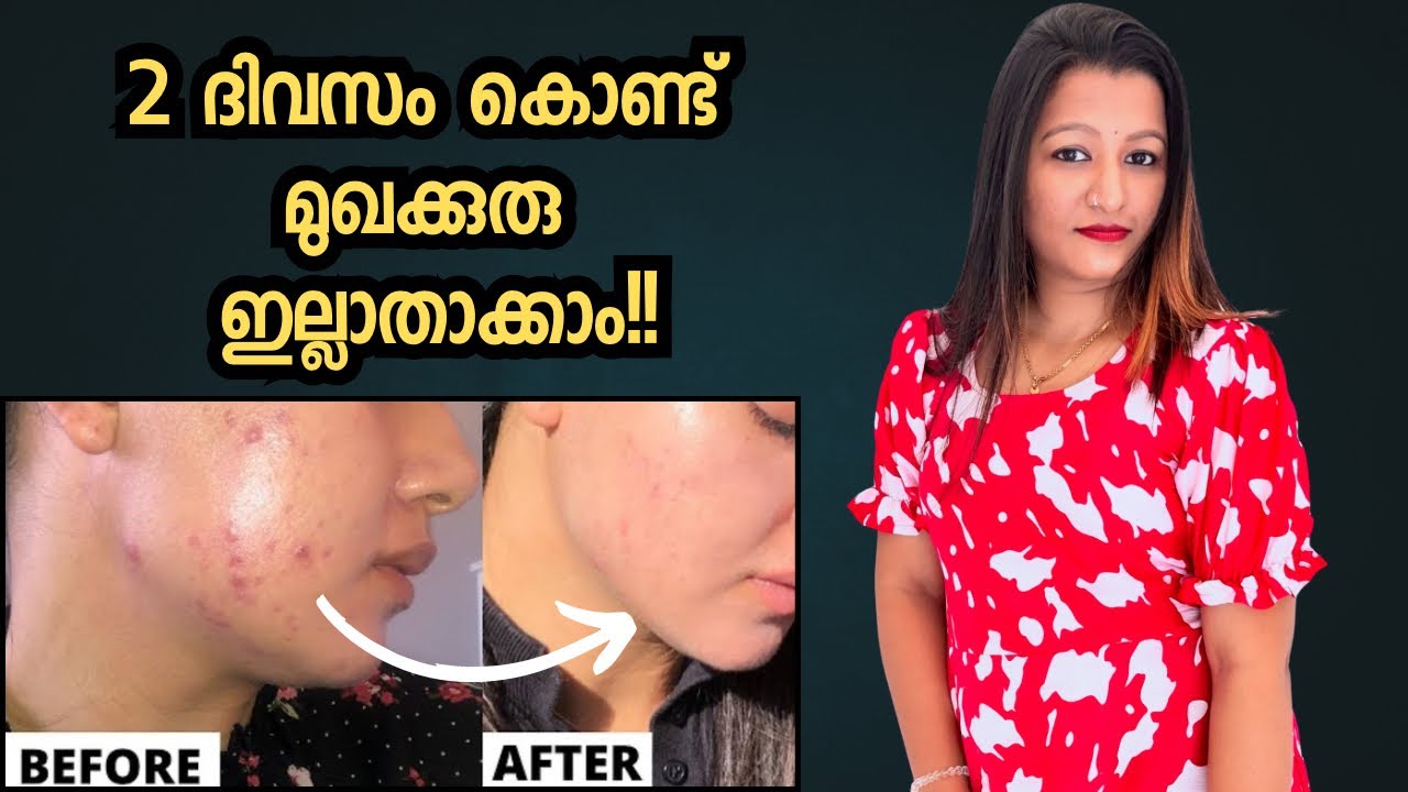 Remove Pimples At Home In 2 Days 🤩 