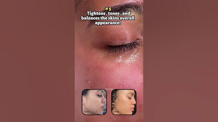 5 reasons why your skin needs a chemical peel 💫 by a nys licensed esthetician 💕