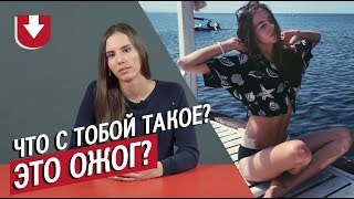 Люди с витилиго (белыми пятнами по всему телу) | Неудобные вопросы