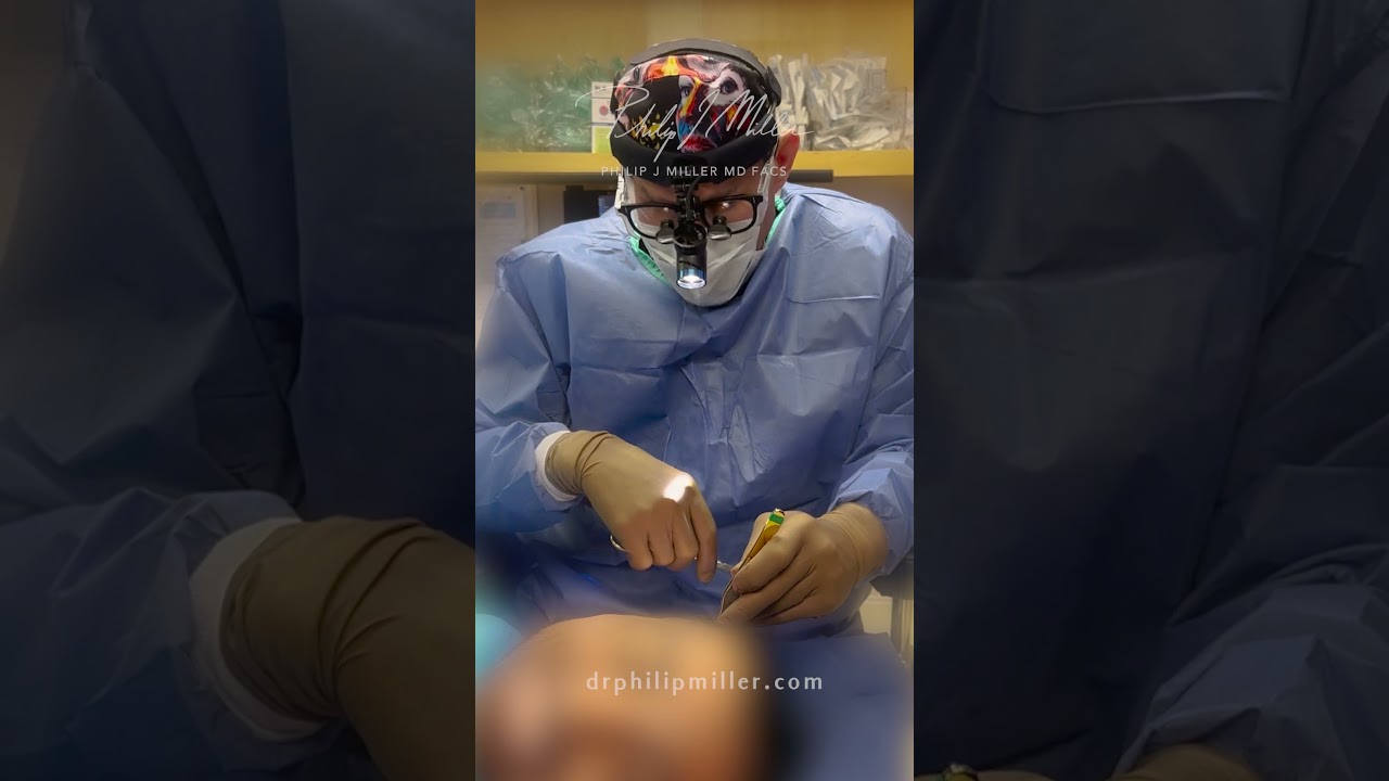 MicroLift-Face! Local Anesthesia and Fast Recovery!