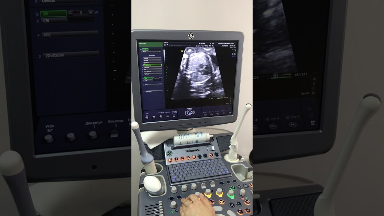 Второй скрининг УЗИ 24 недель - YouTube