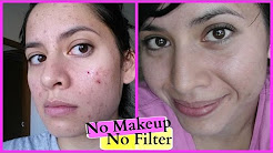 HOW I HEALED MY ACNE SCARS FAST - Miraculous Results!!