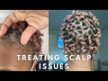 Hair Update: Flakes, scabs, &amp; a solution | Brittany&#39;s Room