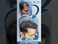 Best Hair Transplant Clinic in Delhi | Before After Best Results | Cost of Hair Transplant in Delhi