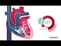 Implantable Cardioverter Defibrillator - ICD - Therapy (Movie 6 BIOTRONIK)