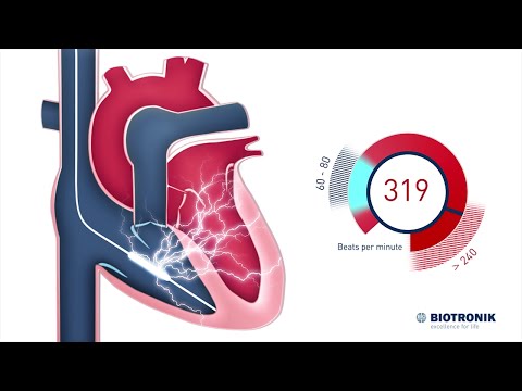 Video: Vsadljivi Kardioverterski Defibrilator (ICD)
