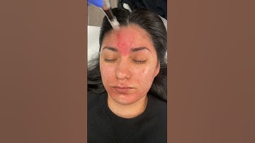 MICRONEEDLING BENEFITS