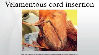 Velamentous cord insertion