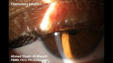 Filamentary keratitis