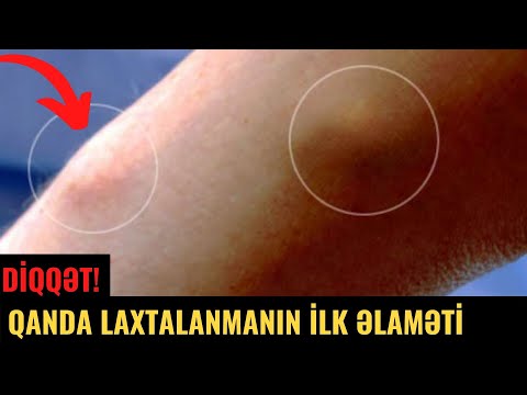 Qanda LAXTALANMANIN İLK ƏLAMƏTİ - QAN DURULDAN VASİTƏLƏR