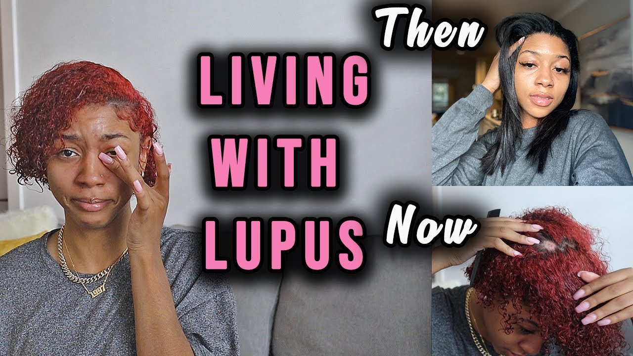 Living with Lupus at age 23: My skin and hair is getting worse.....