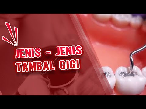 Jenis Tambal Gigi beserta Keunggulannya - Dental Universe Indonesia