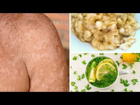 3 Natural Remedies for Treating Tinea Versicolor at Home (Pityriasis Versicolor)