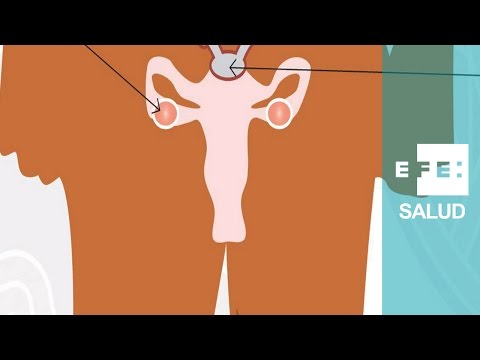Vídeo: Tumores Malignos Del Sistema Reproductor Femenino