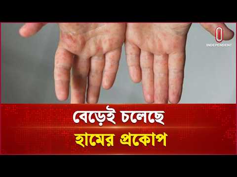 বরিশালে হামের উপসর্গ নিয়ে আরও ২ শিশুর প্রাণ গেল | Measles | Barisal | Independent TV