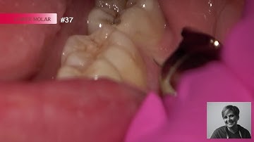 Painless Intraosseous Anesthesia