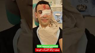 عملية إزالة الندبات الوجه خلال عشرين دقيقة علاء_خلف المغرب الجزائر لبنان المانيا فلسطين برلين