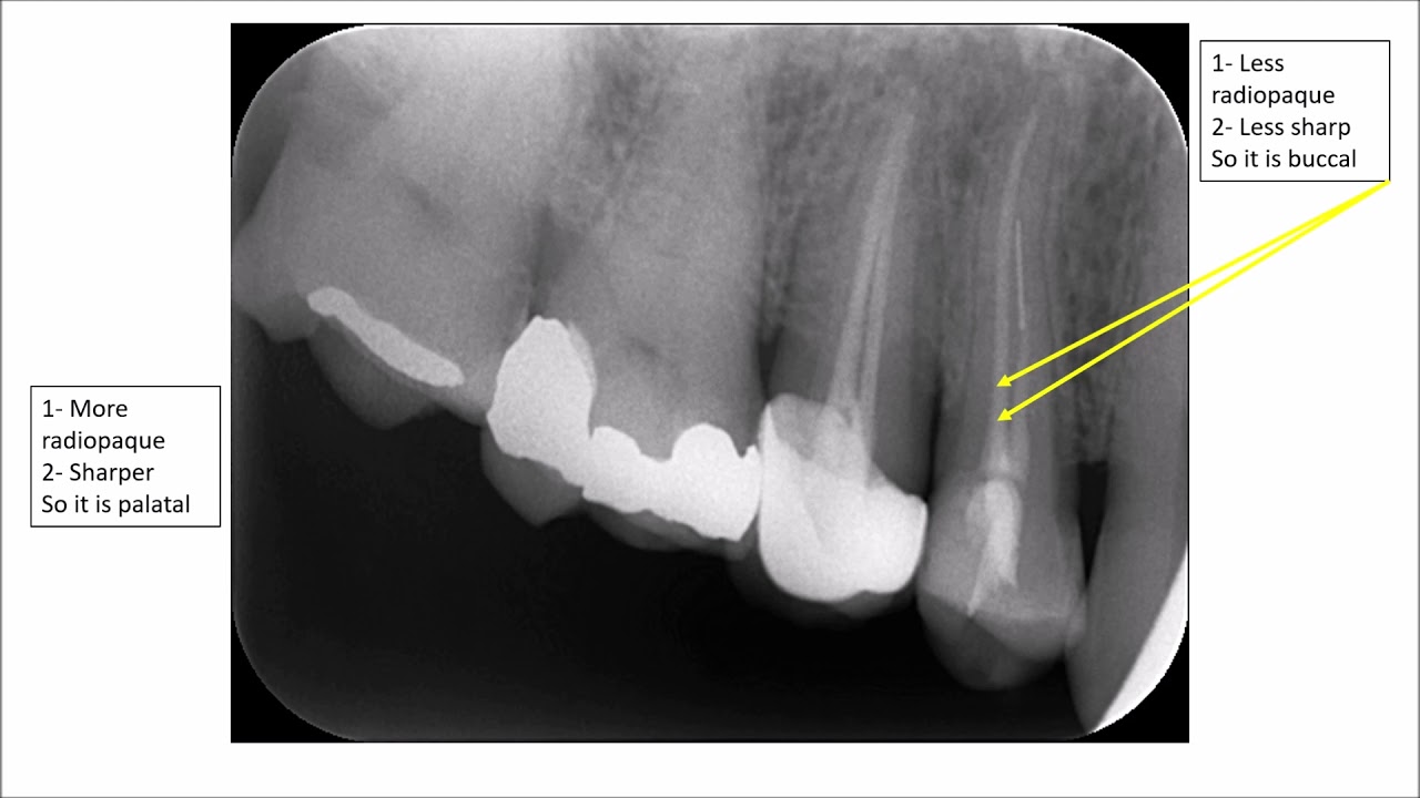 How to Locate the Position of Structures in 2D Radiographs 3 - YouTube