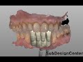 3shape design anterio teeth lowerimplant  3shape     