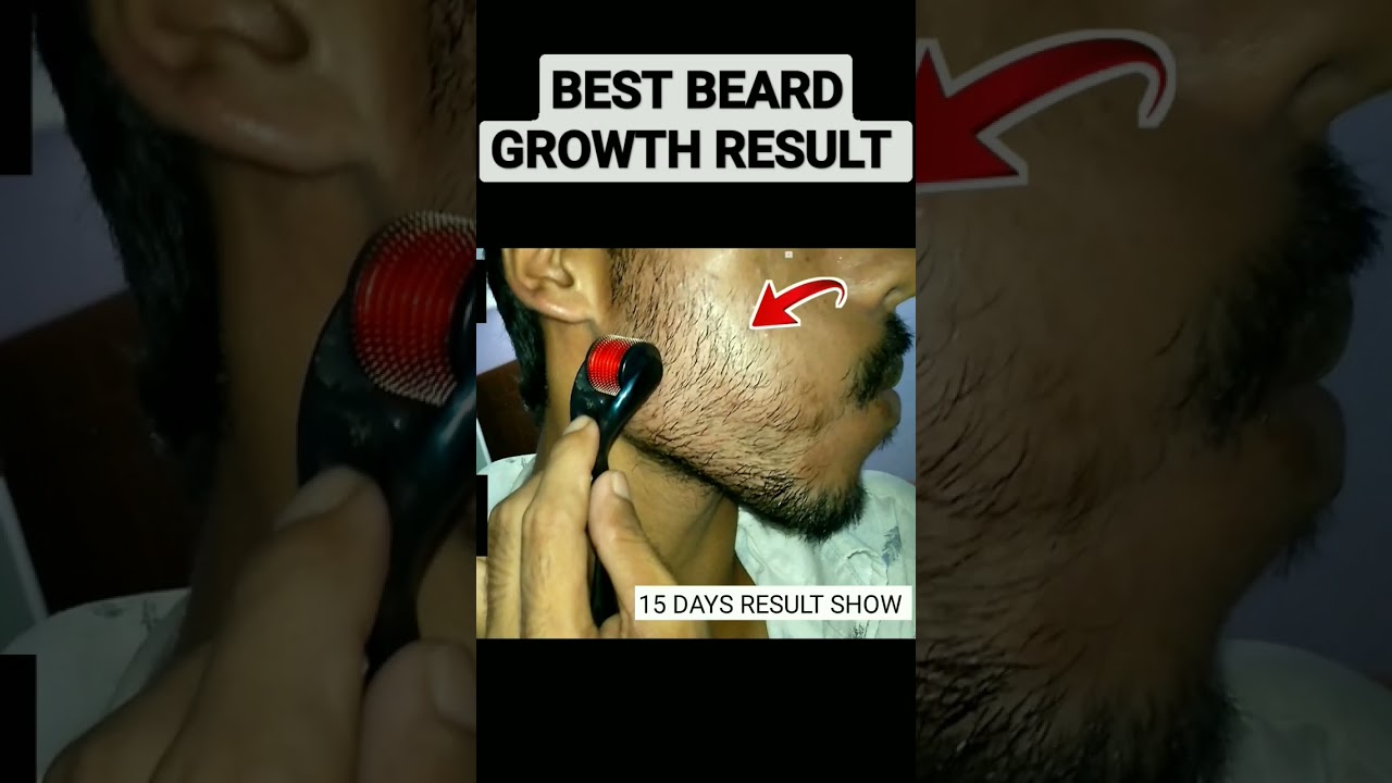 How to grow a full beard from minoxidil | Beard growth | 