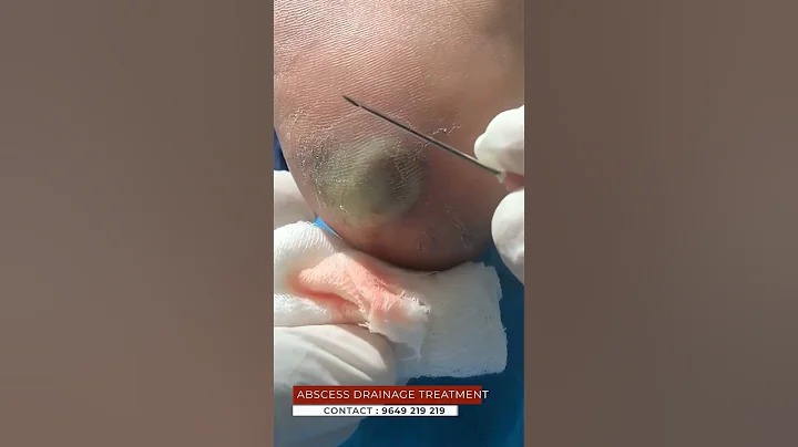 Think Abscess Drainage Treatment Is Too Good to Be True? We Have News for You | viral #shorts - DayDayNews