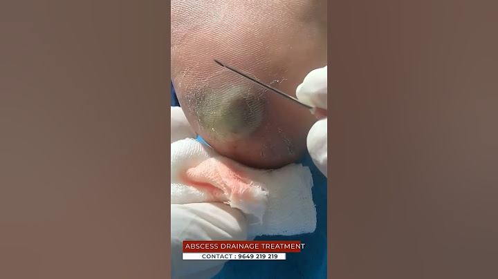 Think Abscess Drainage Treatment Is Too Good to Be True? We Have News for You | viral #shorts