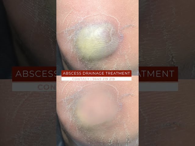 Think Abscess Drainage Treatment Is Too Good to Be True? We Have News for You | viral #shorts class=