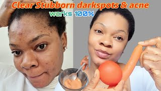 How To Remove Stubborn Dark Spots, Acne Pimples..look Younger