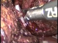 Dr hitesh chavda ahmedabad  laparoscopic  pericystectomy for liver hydatid cyst