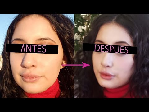 Vídeo: Edema Facial: ¿por Qué Se Hincha La Cara Por La Mañana? ¿Razones Para Eliminar La Hinchazón De La Cara?