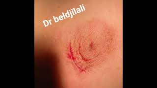 Dr beldjilali aek résection d'un nodule retro mamelonnaire et suture esthétique