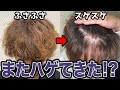 【事件発生!!】植毛して4年半経過したら2年ぶりにハゲてきました...。