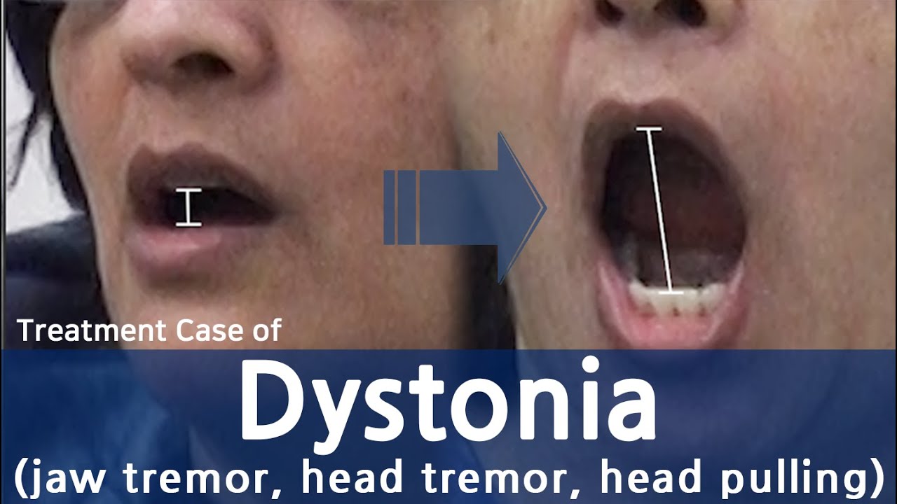 Dystonia ( (jaw tremor, head tremor, head pulling) / trismus / gait